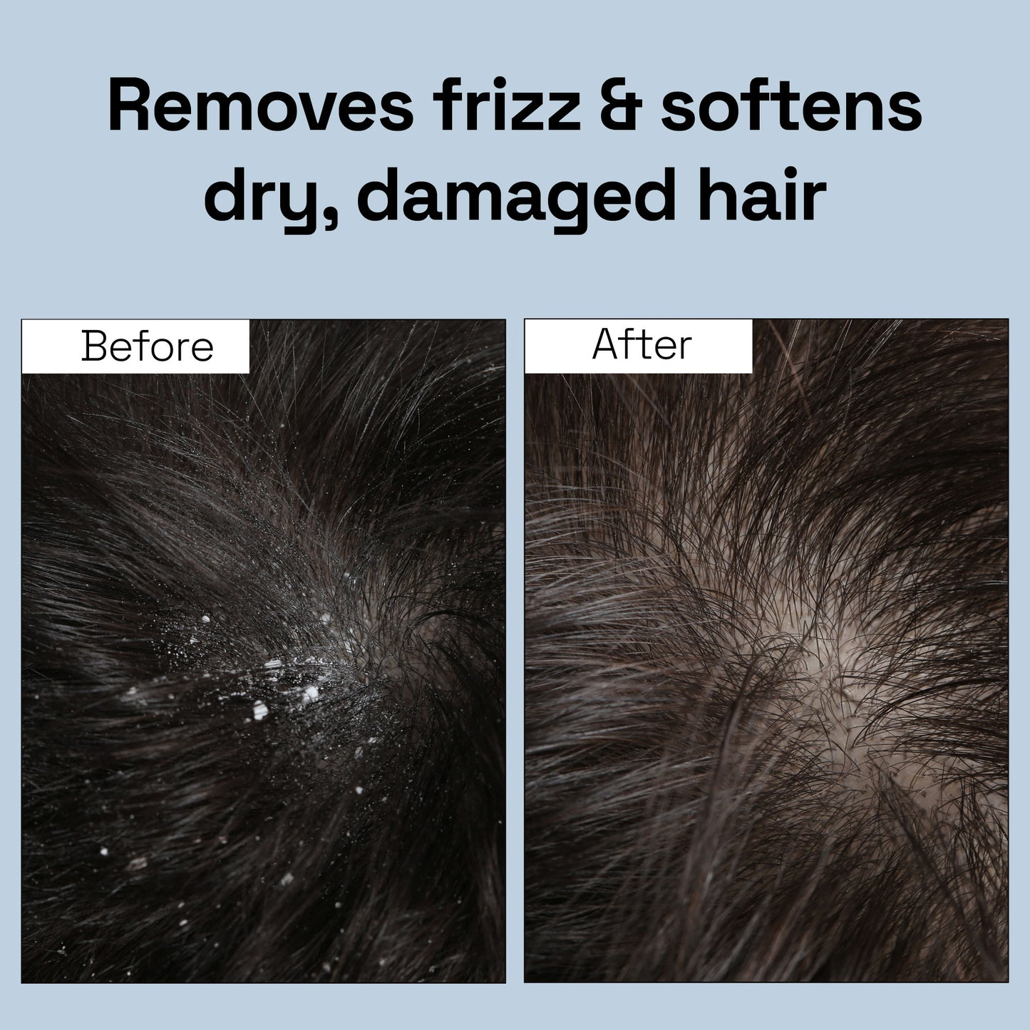 Soulflower Tea Tree Hair Oil For Scalp & Dandruff